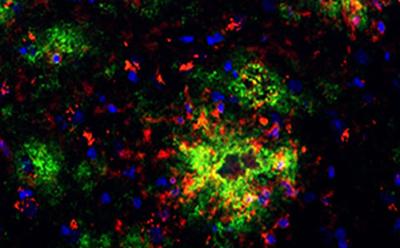 Amyloid beta plaques
